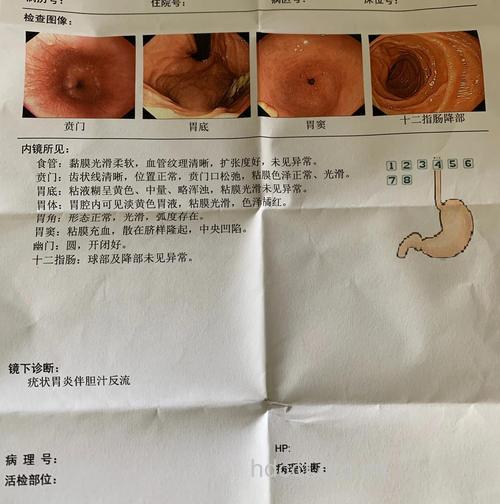 胃溃疡引起胃出血 胃镜检查必不可少