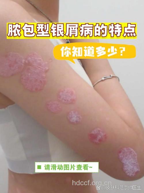 脓胞型银屑病诊断和治疗
