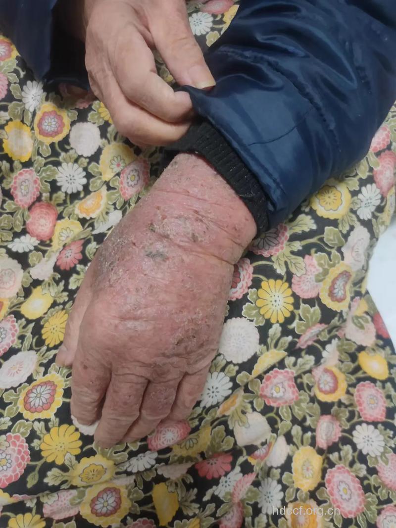 老年银屑病患者的特点