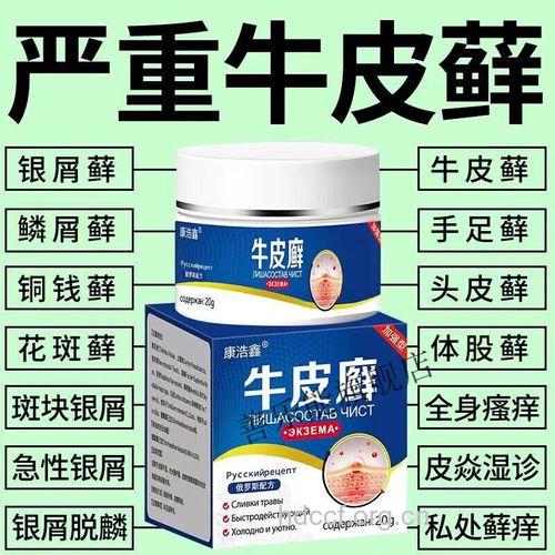 俄罗斯发现牛皮癣原因