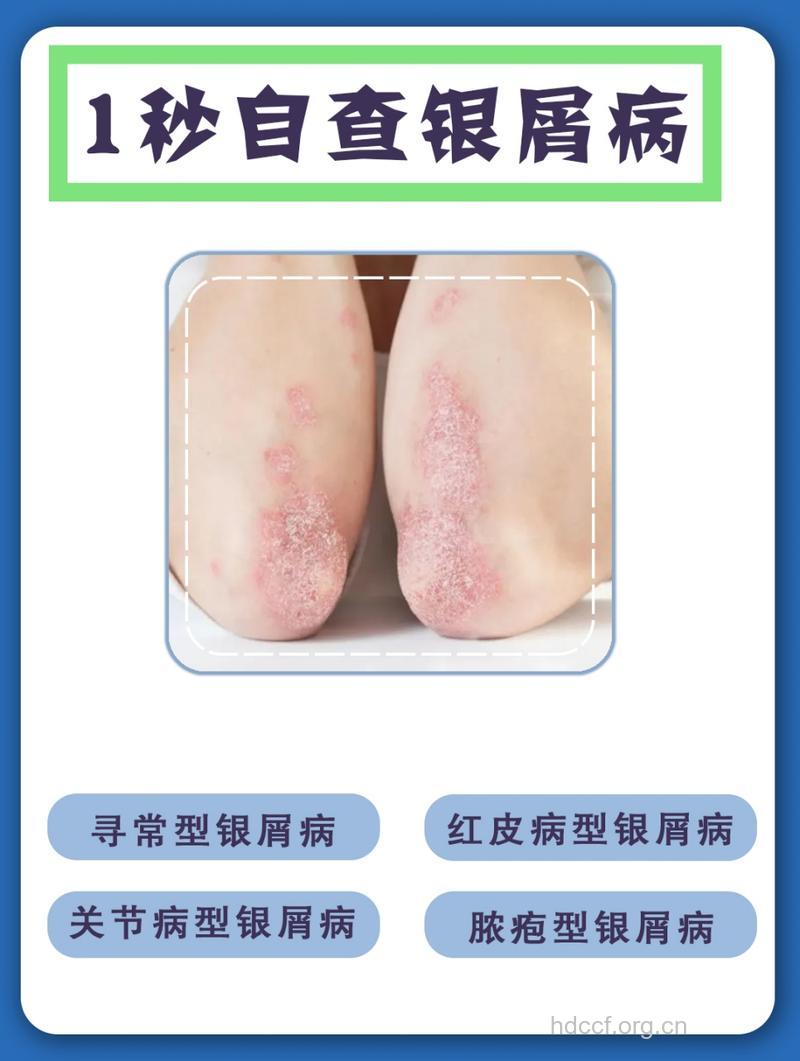 寻常型银屑病的几个时期