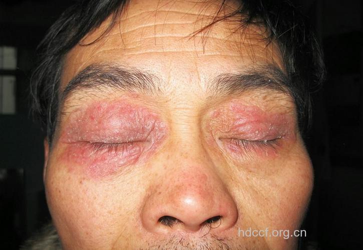 神经性皮炎浅析