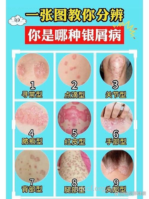银屑病的鉴别诊断