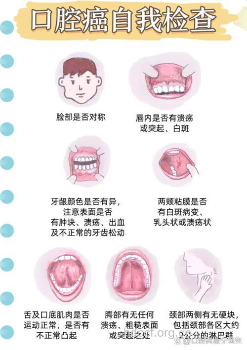 口腔癌有哪些疾病征兆