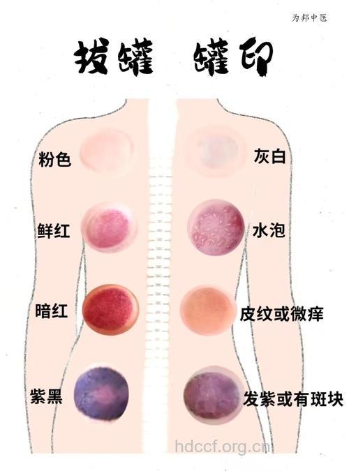 拔罐需要注意的七个问题 要注意了