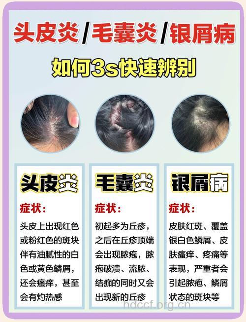 女性比男性更容易患有银屑病吗