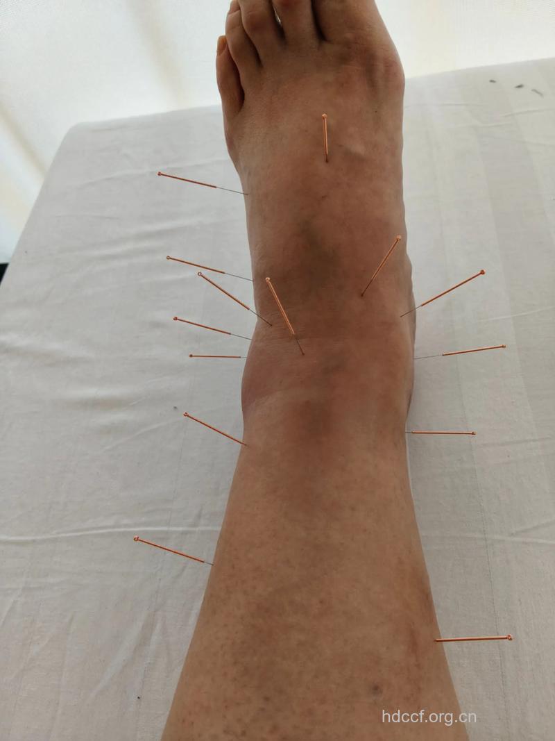 骨折怎么办 针灸治疗有效果