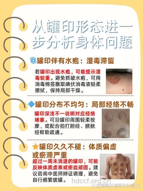 拔罐后的印记告诉你身体状况