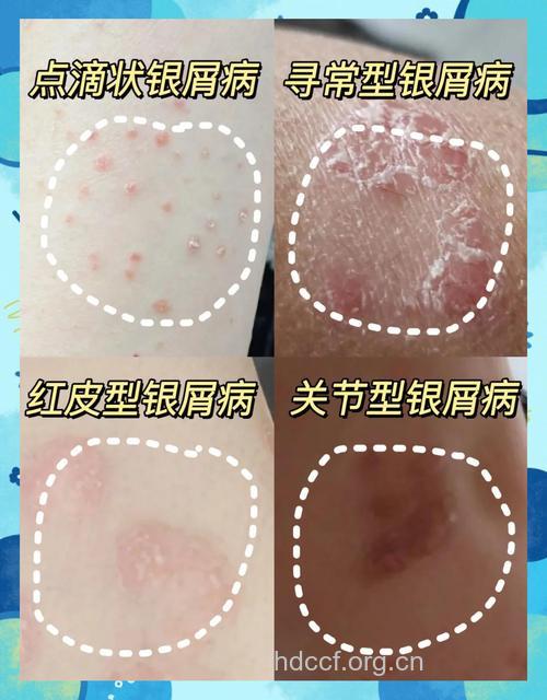 银屑病有什么临床特征呢