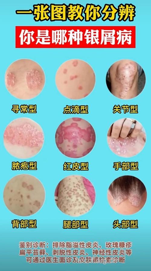 银屑病