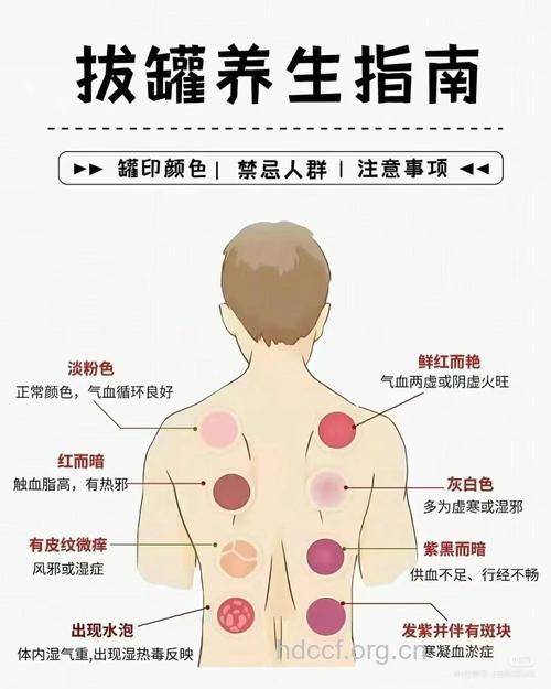 中医通过拔罐辨别体质 不是哪里痛就拔哪里