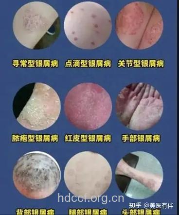 银屑病治疗时的各种骗局