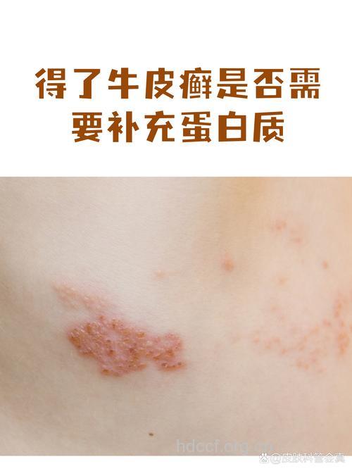 牛皮癣患者为什么要补充蛋白质