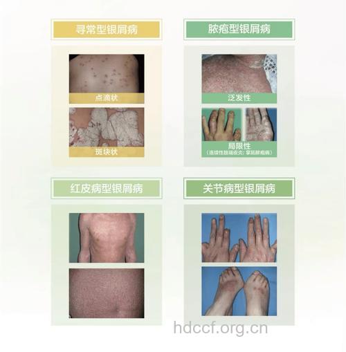 生殖器银屑病有哪些症状