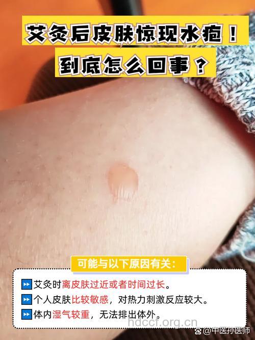 艾灸出水泡怎么回事 还可以继续吗