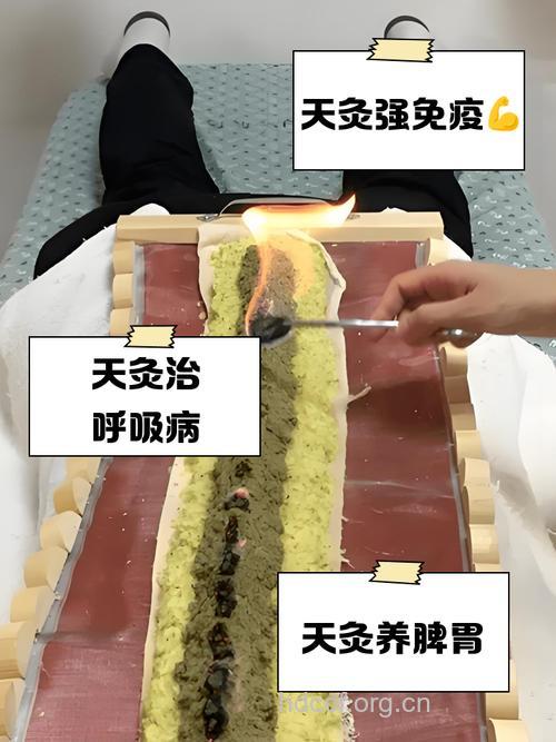 天灸的临床施灸方法有哪些