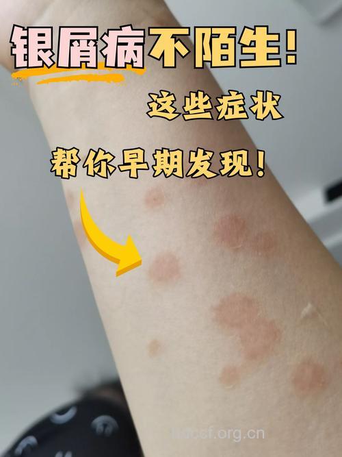 牛皮癣、糖尿病等3种基因有望破译