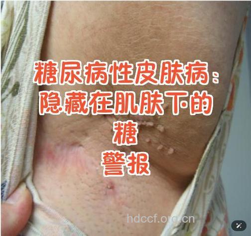 小儿皮肤病 警惕有糖尿病