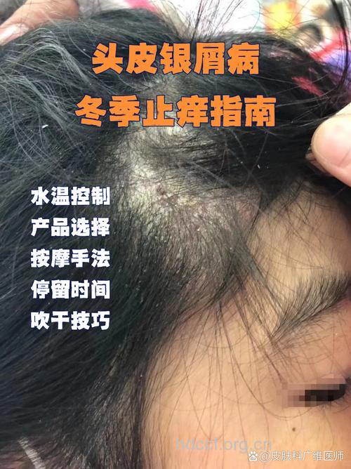 头部牛皮癣患者少用电吹风