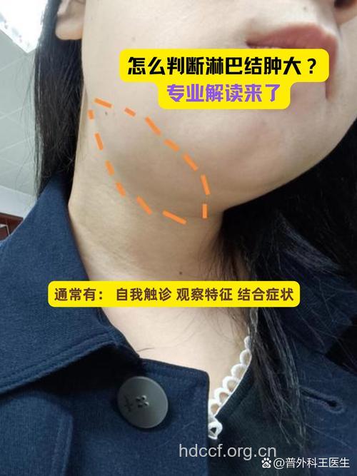 颌面部淋巴管瘤症状诊断有哪些