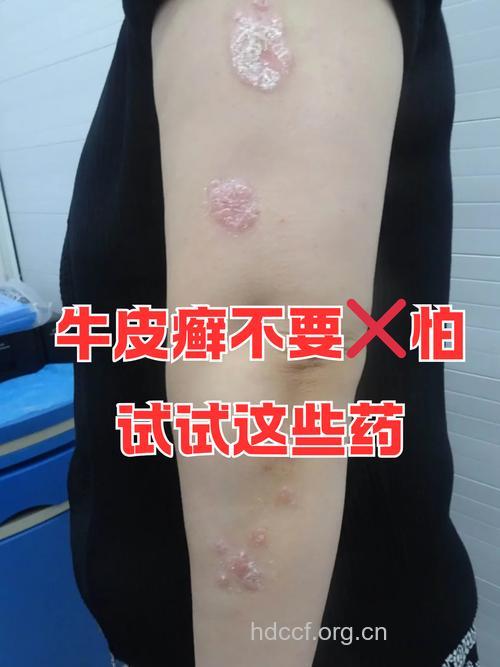治疗牛皮癣宜多活动多出汗