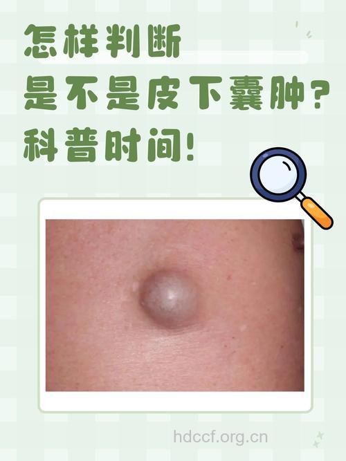表皮囊肿症状是什么