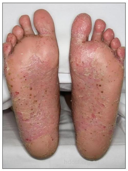 局限的脓疱病型银屑病的分型
