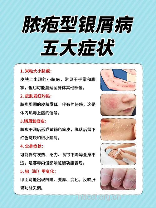 脓胞型银屑病的诊断和治疗