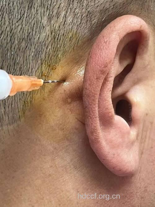 耳针治疗银屑病