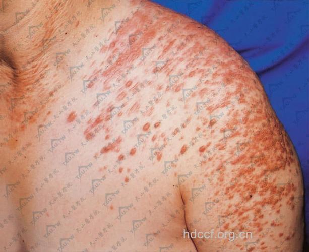 皮肤平滑肌瘤症状表现是什么