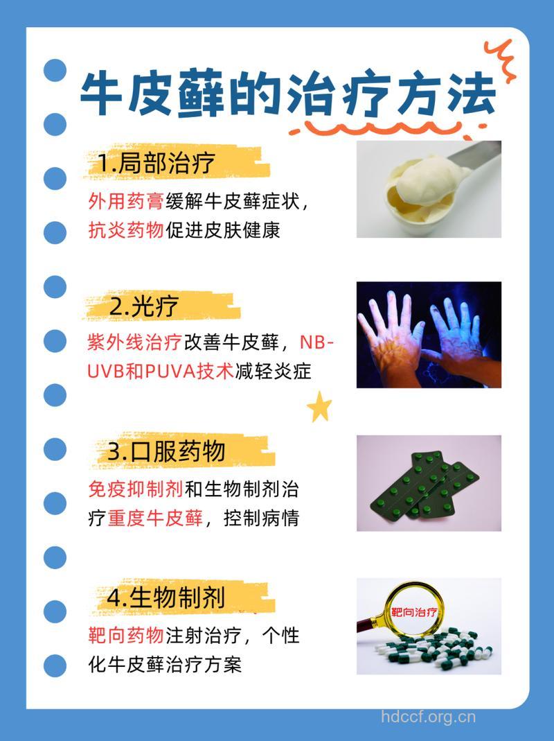 银屑病治疗的研究进展