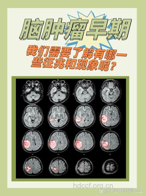 良性脑肿瘤早期的症状
