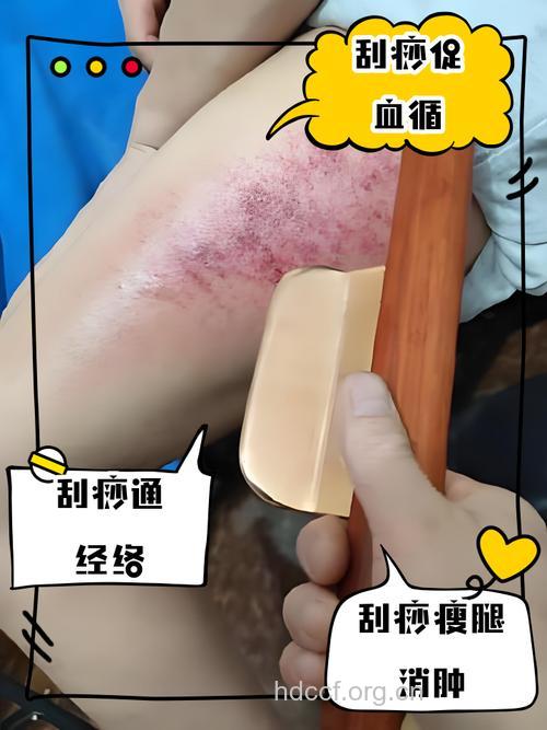满肚子宿便超毒!中医“大腿刮痧”来帮忙