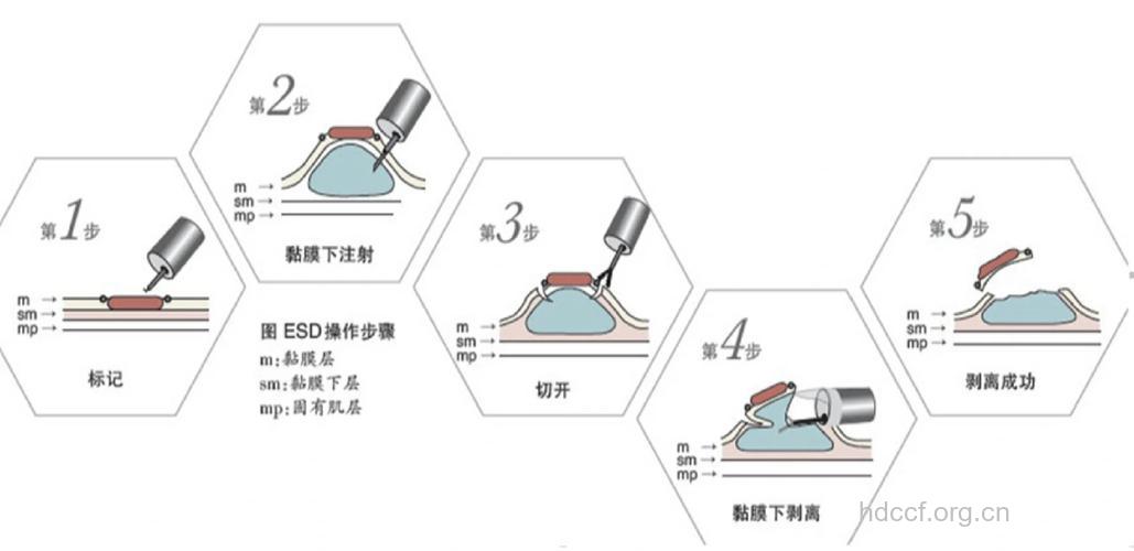 良性肿瘤怎么进行手术治疗