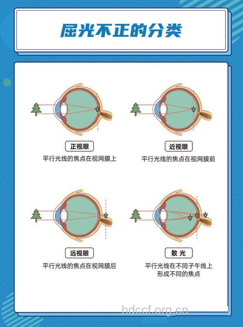 屈光不正要注意哪些？