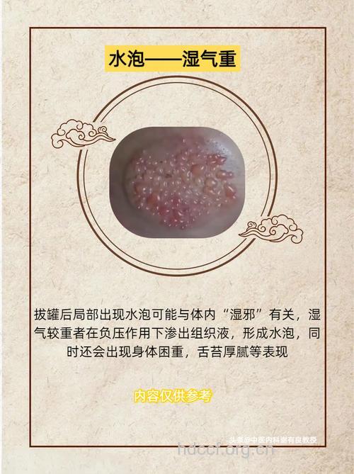 拔罐后为什么湿气越重 中医告诉你原因