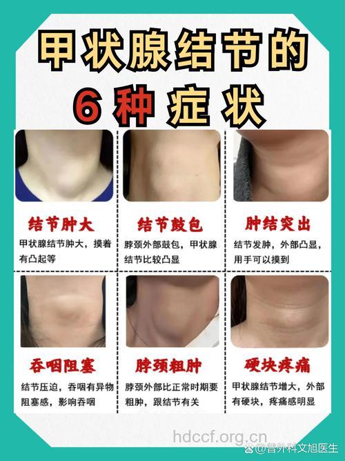 甲状腺良性肿瘤形成原因是什么