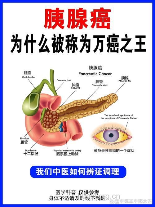 胰腺良性肿瘤的病因是什么