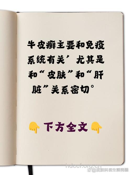 牛皮癣与肝脏的关系