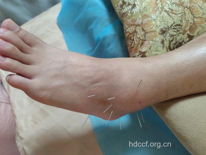 痛风难忍 中医古法针灸助您摆脱痛风