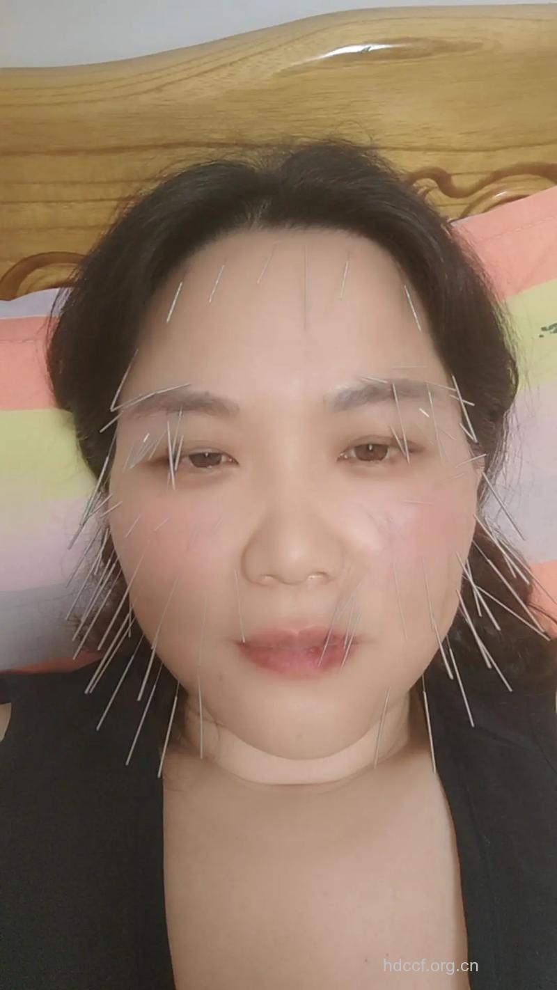 针灸能减肥 让你瘦成V形脸