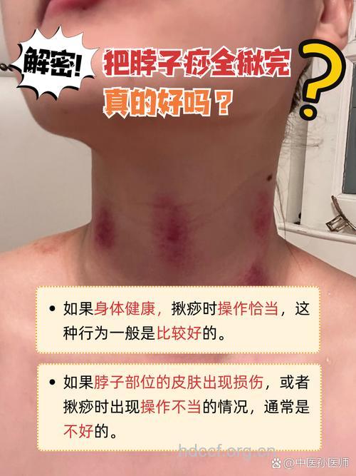 脖子刮痧出痧怎么回事 说明什么