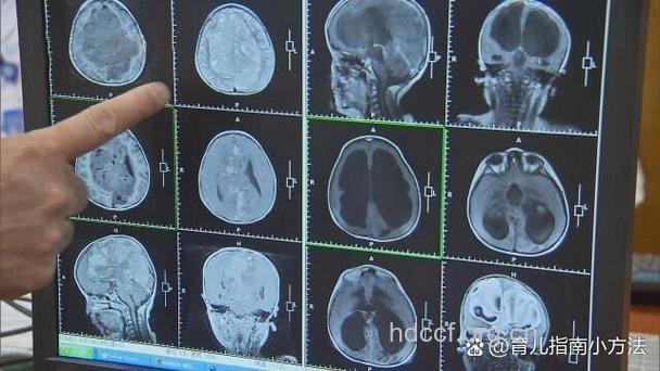 为什么导致小脑肿瘤误诊
