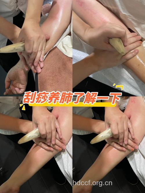 刮痧能治肺痨吗 肺痨的刮痧疗法