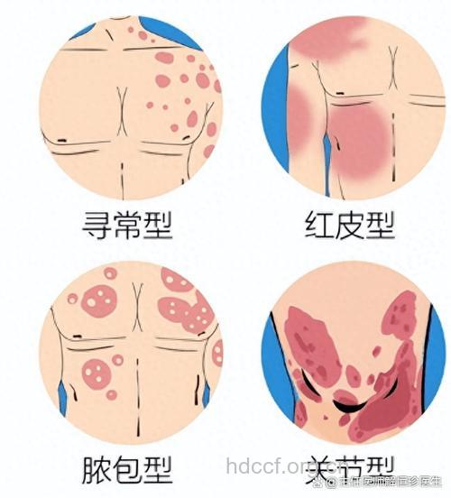 分析牛皮癣与白血病