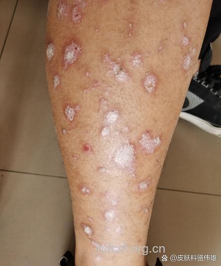 电脑对牛皮癣患者有危害