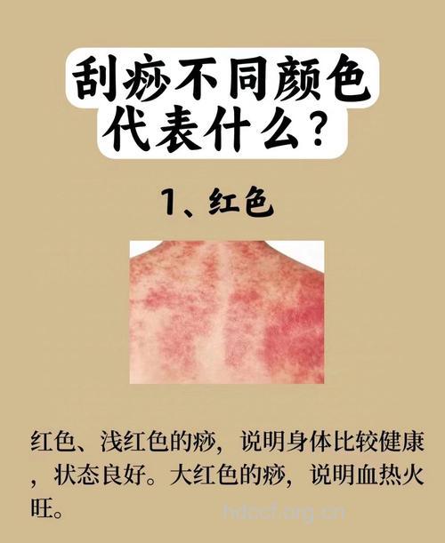 刮痧部位颜色并非越黑越好
