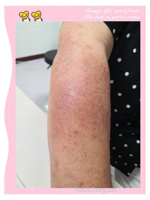 光敏性牛皮癣有什么特点