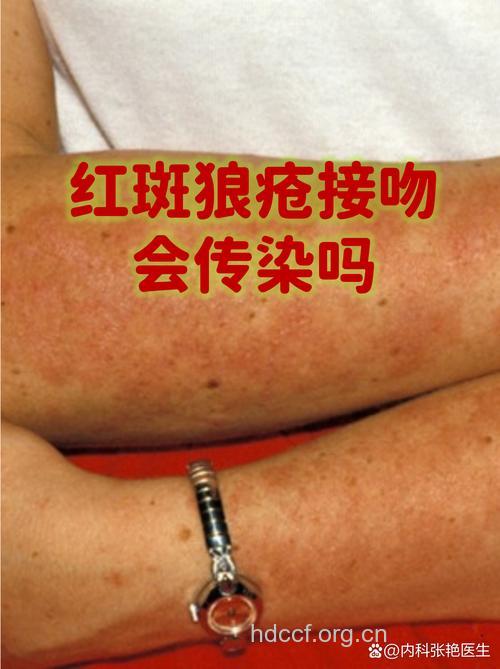 接吻会传播皮肤癌病毒吗