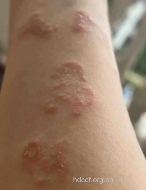 牛皮癣患者平时可以多晒晒太阳